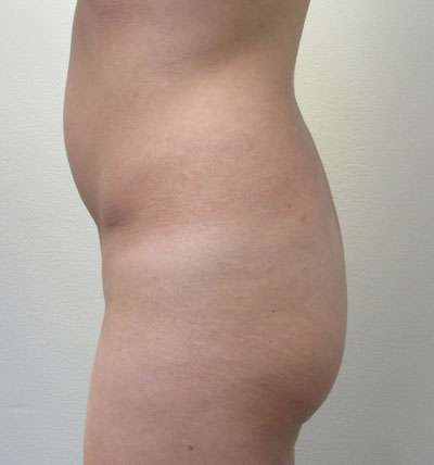 Brazilian Butt Lift Before & After Patient #6378