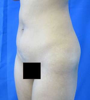 Brazilian Butt Lift Before & After Patient #6548