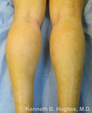 Calf Augmentation & Implants Before & After Patient #11546