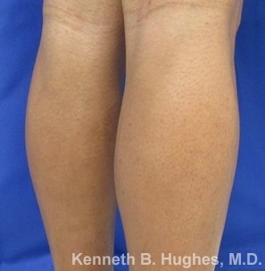 Calf Augmentation & Implants Before & After Patient #11542