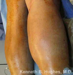 Calf Augmentation & Implants Before & After Patient #11542