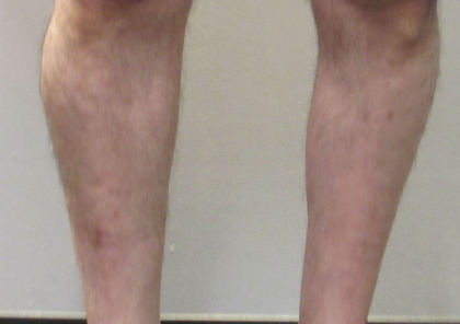 Calf Augmentation & Implants Before & After Patient #11536