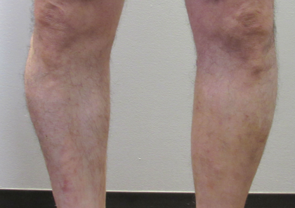 Calf Augmentation & Implants Before & After Patient #11536