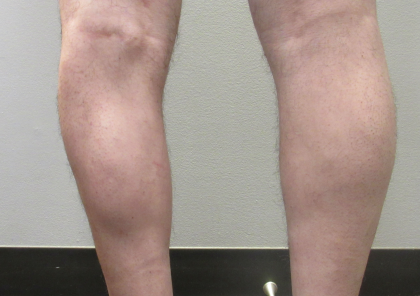 Calf Augmentation & Implants Before & After Patient #11536