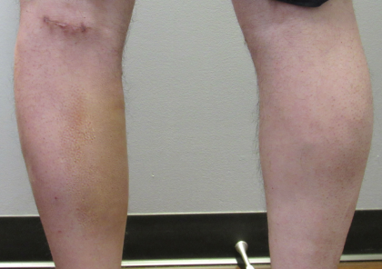 Calf Augmentation & Implants Before & After Patient #11536