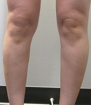 Calf Augmentation & Implants Before & After Patient #11550