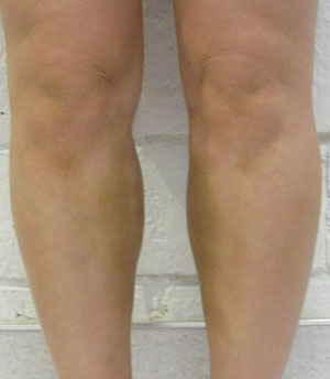 Calf Augmentation & Implants Before & After Patient #11550